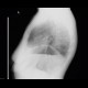 Postoperative pneumoperitoneum: X-ray - Plain radiograph